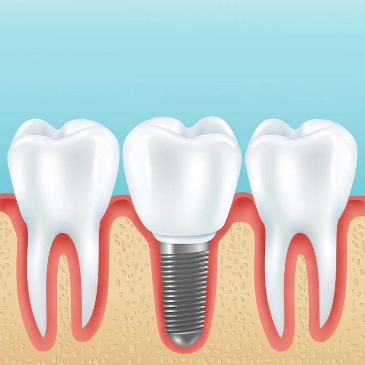 Dental Implants Leamington