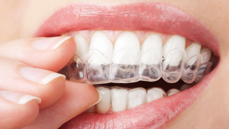 Invisalign Leamington