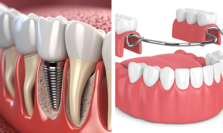 Dental Implants Leamington